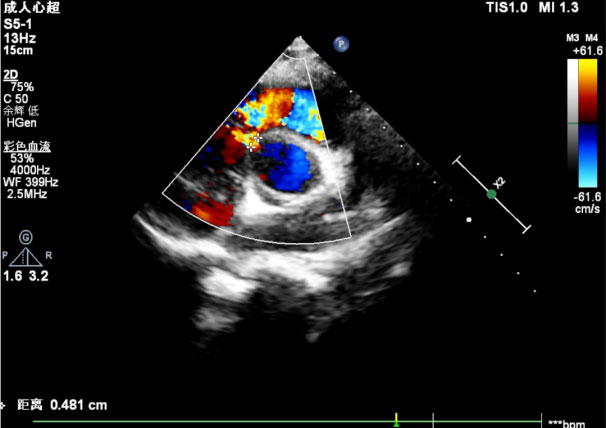 Preoperative-ultrasound.jpg